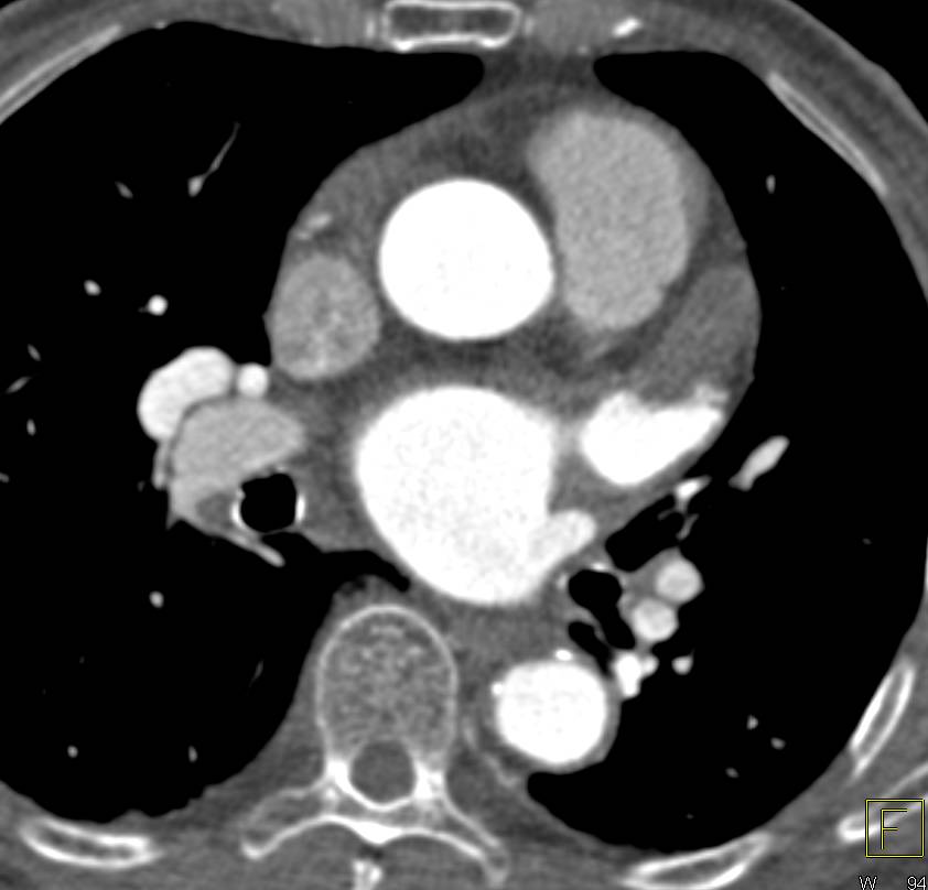 Coronary CTA with Mixed Plaque and a Nice Example of Pseudo clot in the Left Atrial Appendage - CTisus CT Scan