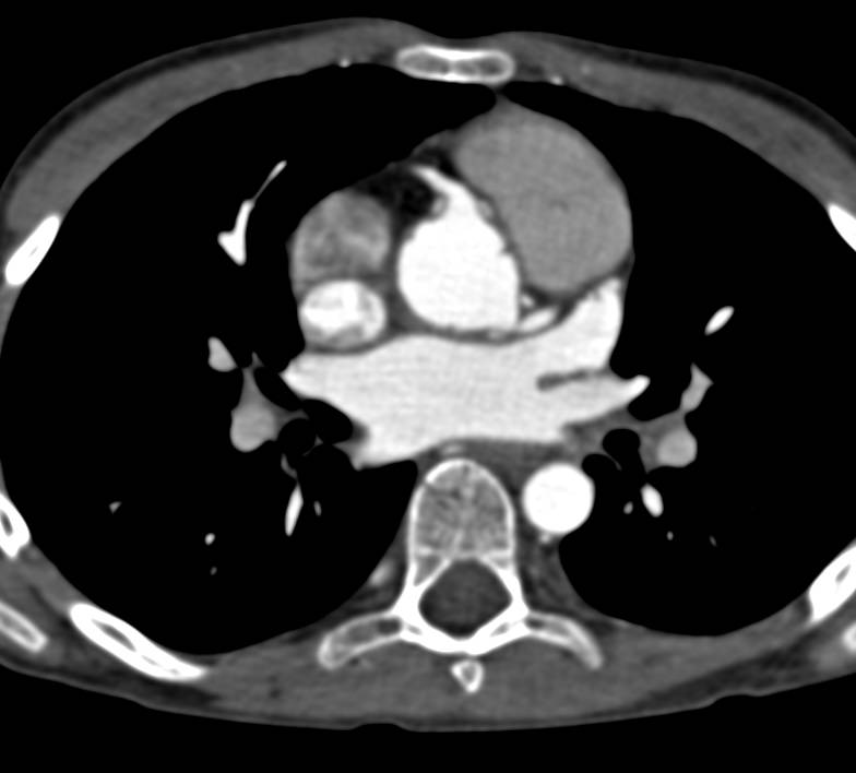 Dilated Reimplanted Coronary Arteries - CTisus CT Scan