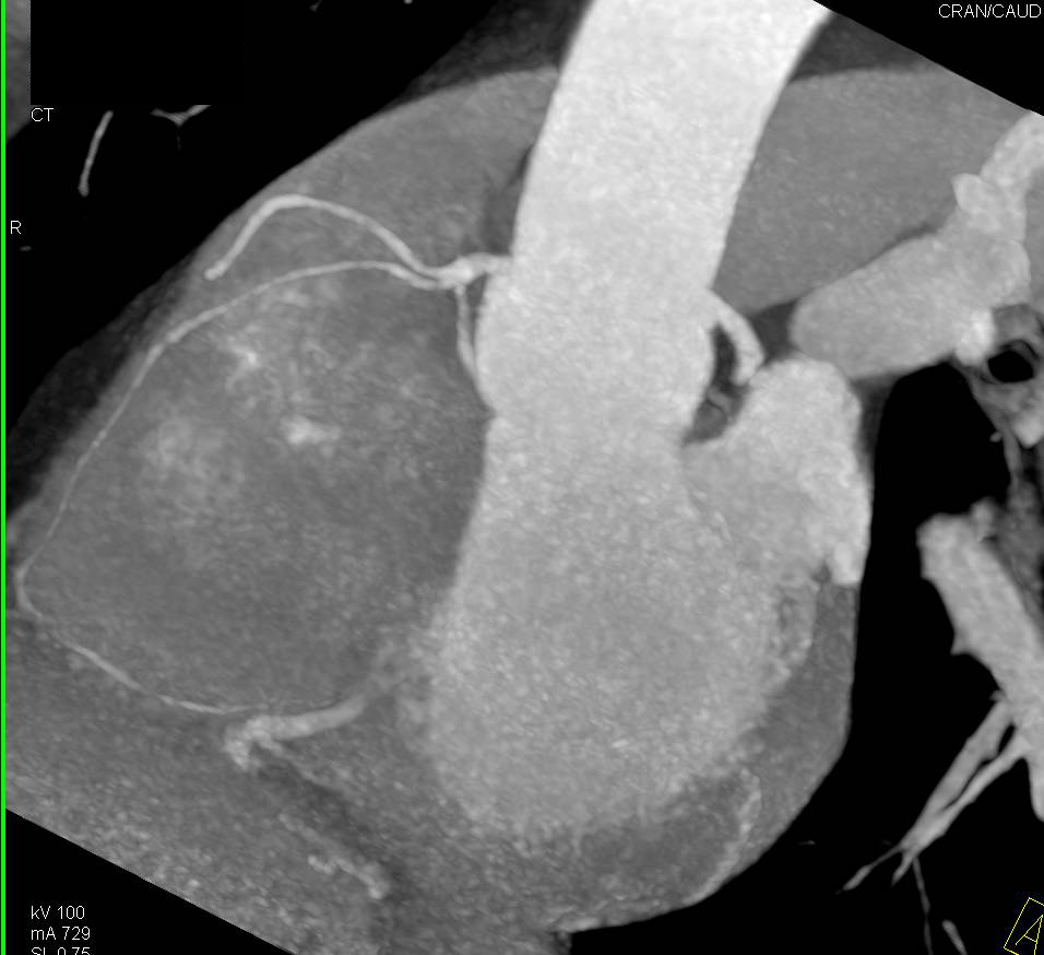 CCTA: Circumflex Coronary Artery Arises off Right Coronary Artery - CTisus CT Scan