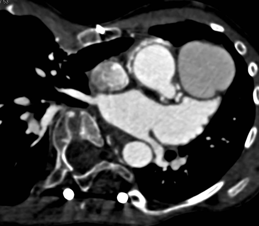 Ascending Aorta Repair in Marfan Syndrome and Dilated Reimplanted Coronary Arteries - CTisus CT Scan