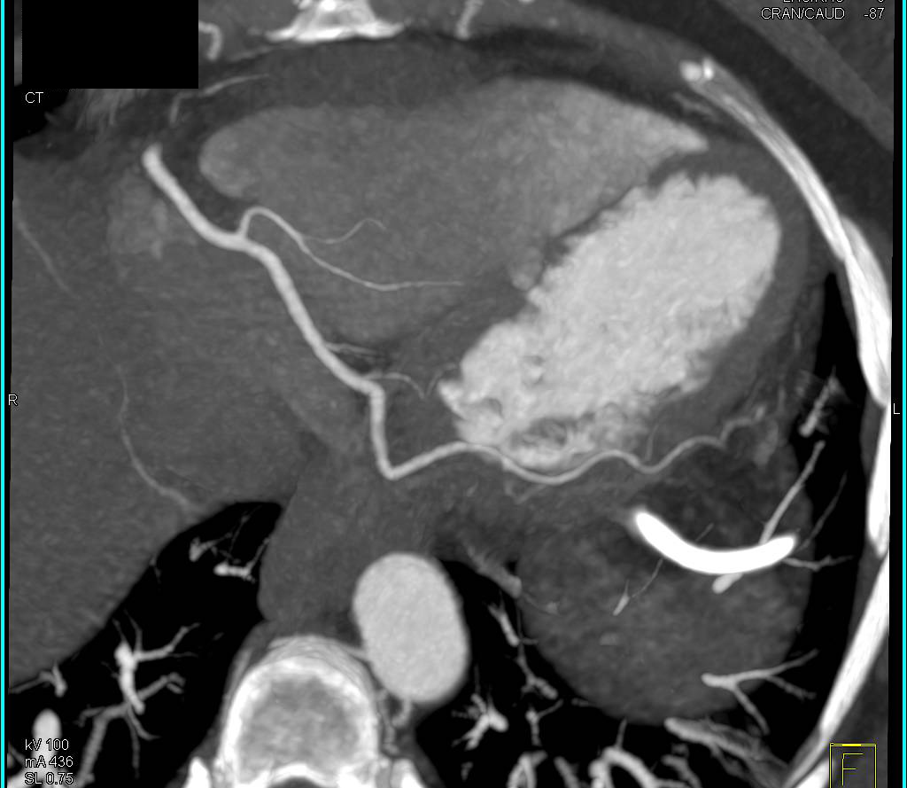 CCTA: 3D Display of Right Coronary Artery - CTisus CT Scan