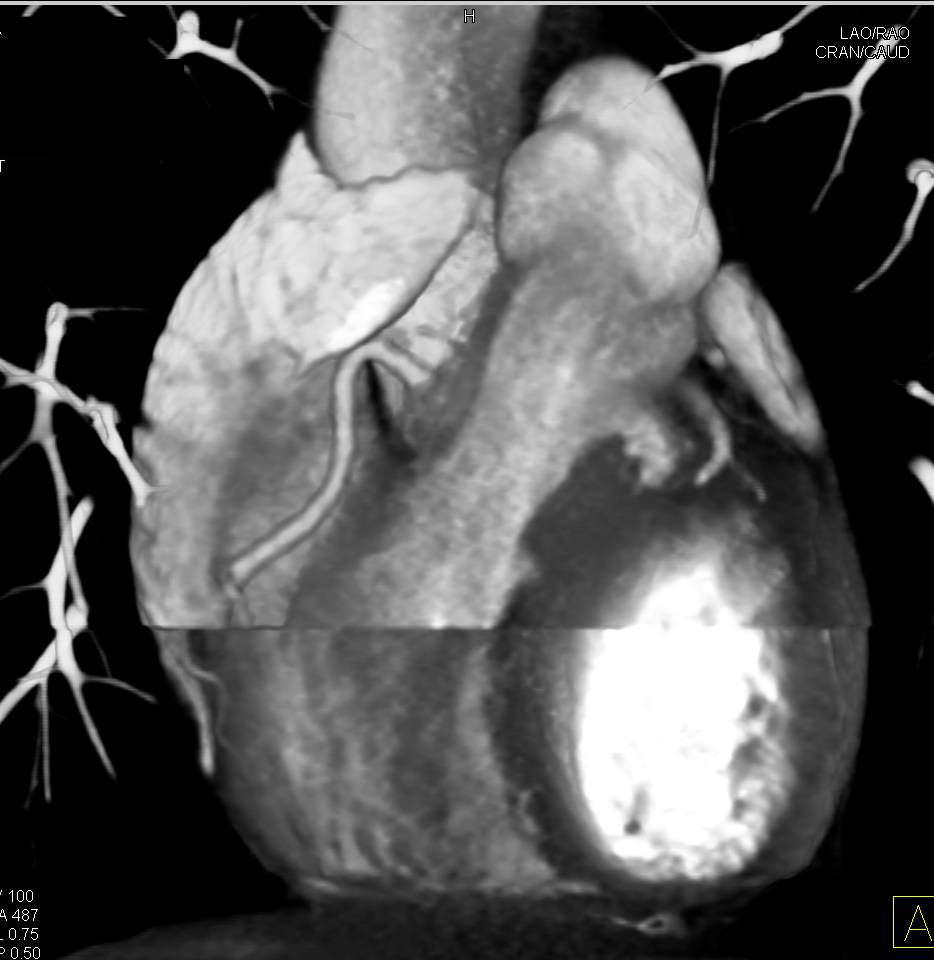 CCTA with Artifact due to Ectopic Beat - CTisus CT Scan