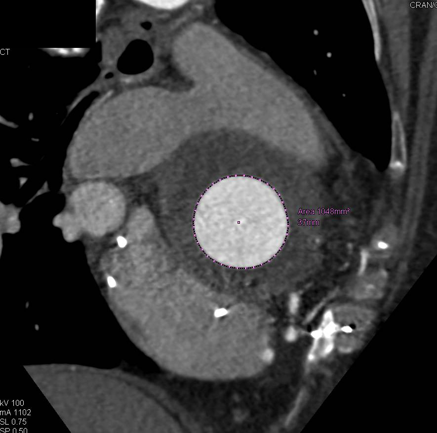 Repair of Aortic Root and Valve with 3D Measurements - CTisus CT Scan