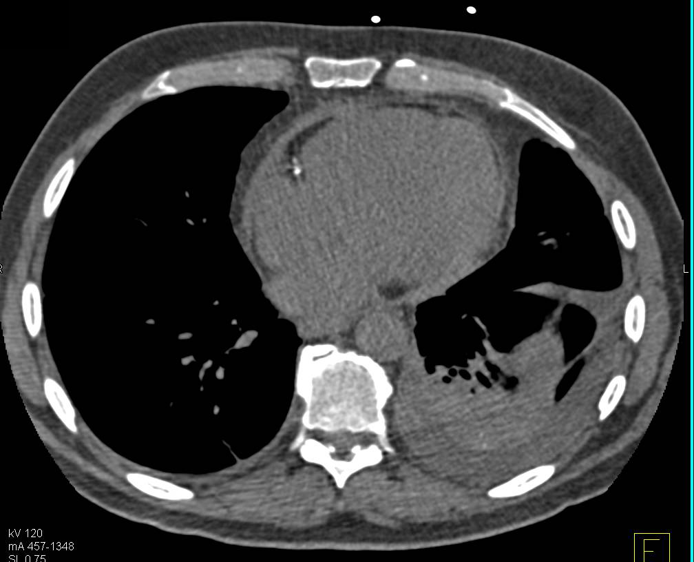 Pericardial Thickening in a Patient with Known Coronary Artery Disease - CTisus CT Scan