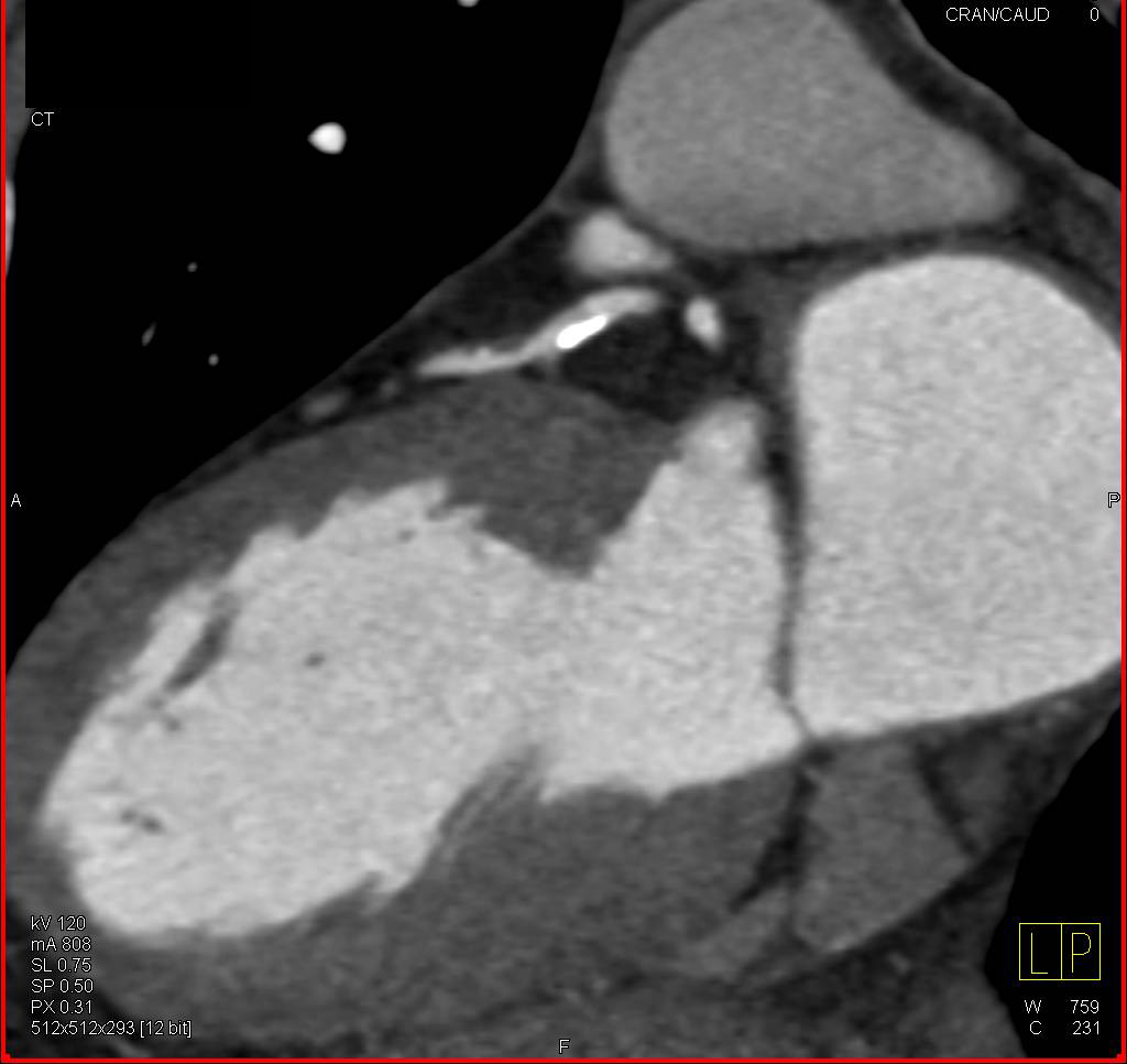 CCTA: Multivessel Disease Especially Left Anterior Descending Coronary Artery (LAD) - CTisus CT Scan