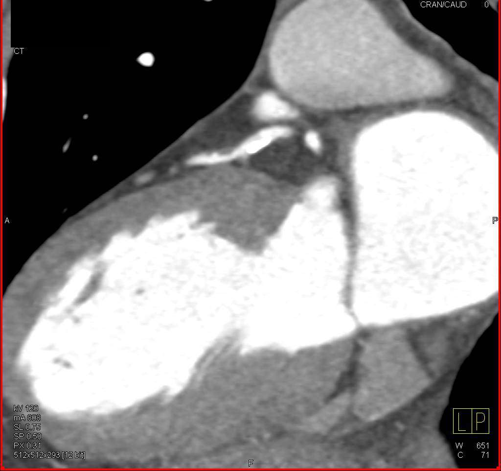 CCTA: Calcified Left Anterior Descending Coronary Artery (LAD) Plaque - CTisus CT Scan