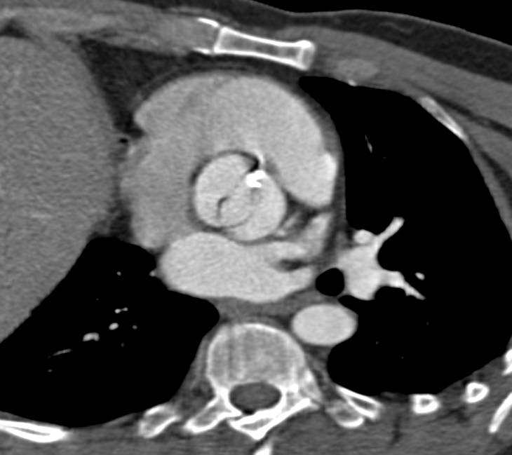 Bicuspid Aortic Valve with Calcification with Dilated Ascending Aorta with Vascular Mapping - CTisus CT Scan