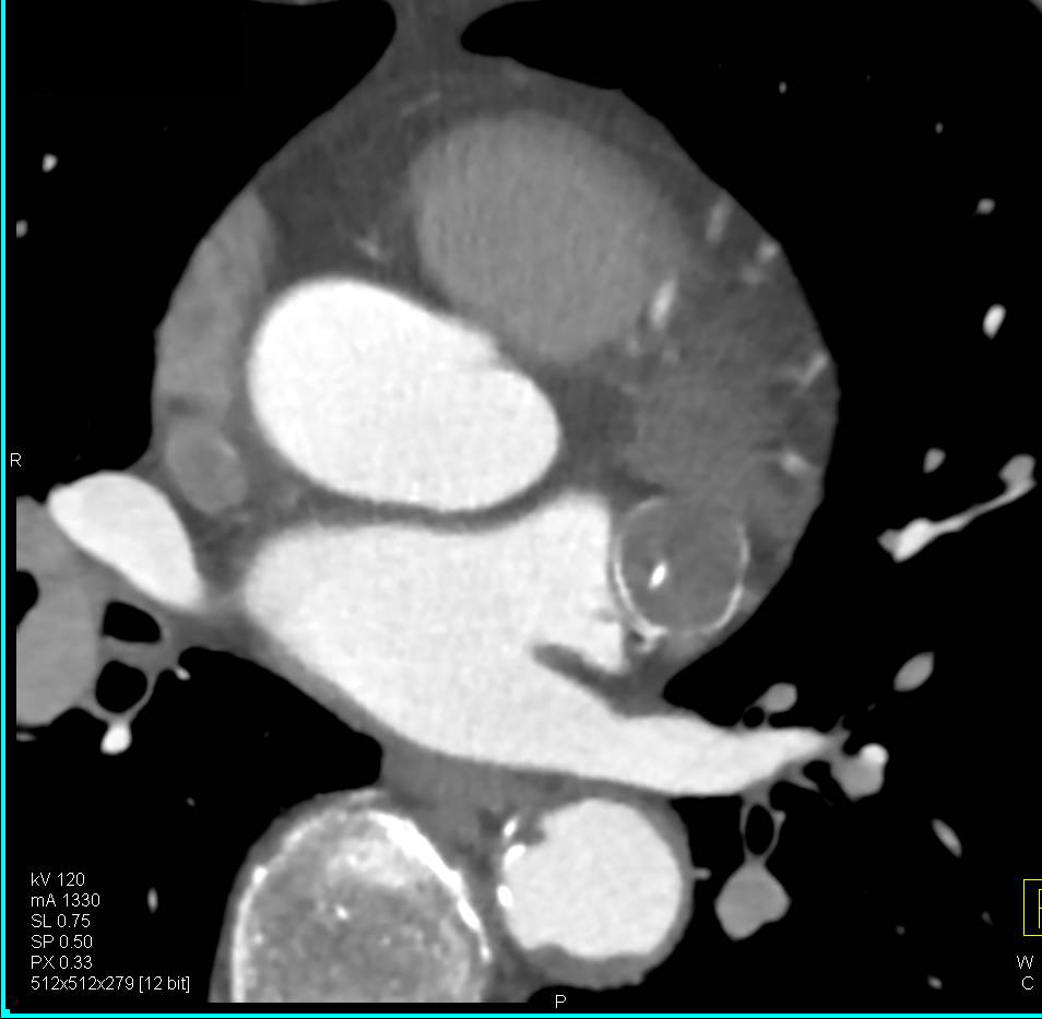 Multiple Perspectives of a Circumflex Coronary Artery Aneurysm - CTisus CT Scan