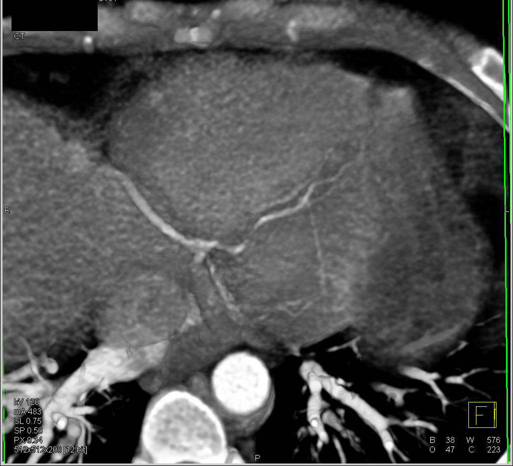 Circumflex Coronary Artery Arises off the Right Cusp in a Non-Malignant Configuration - CTisus CT Scan