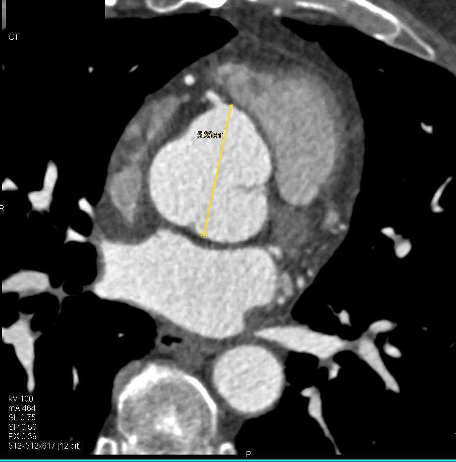 Dilated Sinus of Valsalva in Marfan Patient with Repair of Ascending Aorta - CTisus CT Scan