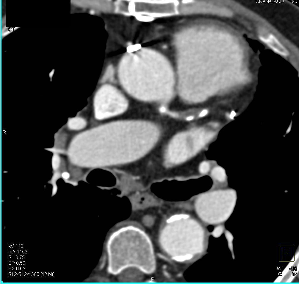 CCTA: Left Anterior Descending Coronary Artery (LAD) Occlusion and Bypass Grafts Then Needed - CTisus CT Scan