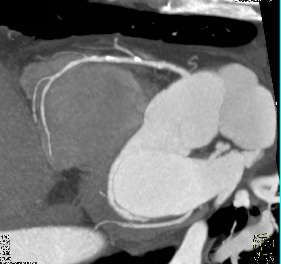 CCTA: Multivessel Disease with Mixed Plaque but no Evidence of a Critical Stenosis - CTisus CT Scan