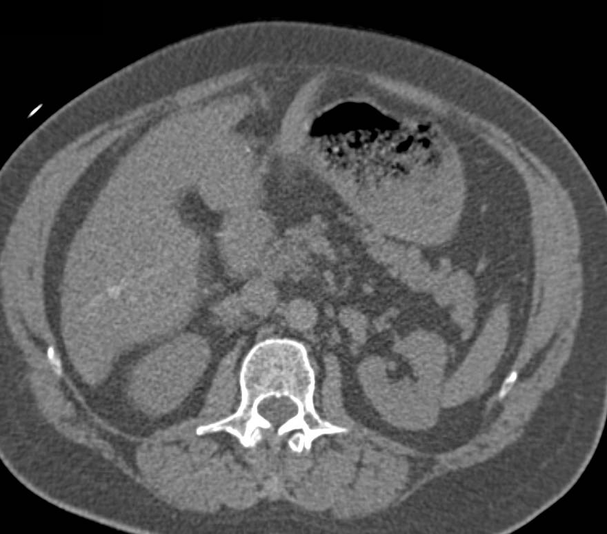 Poor Right Sided Heart Function with Reflux of Contrast into the Inferior Vena Cava (IVC) - CTisus CT Scan