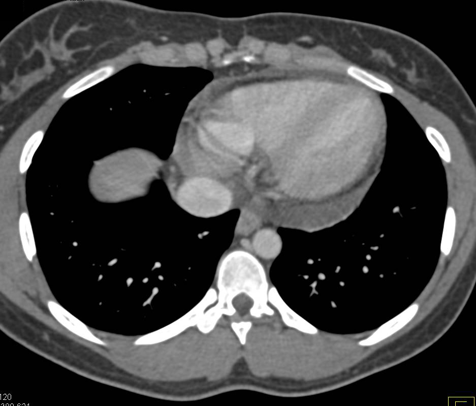 Pericardial Effusion - CTisus CT Scan