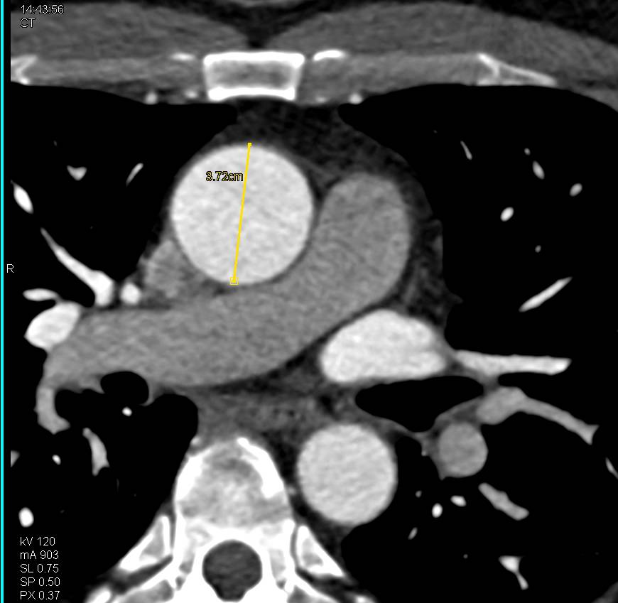 Calcified Aortic Valve with Dilated Ascending Aorta - CTisus CT Scan