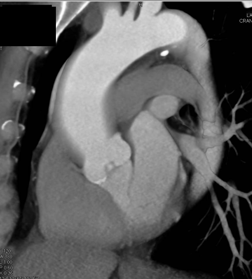 Aortic Valve Calcifications with Aortic Stenosis and Dilated Ascending Aorta - CTisus CT Scan