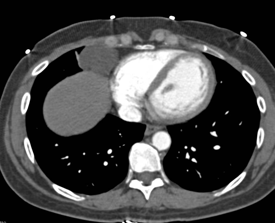 Pericardial Cyst is an Incidental Finding - CTisus CT Scan