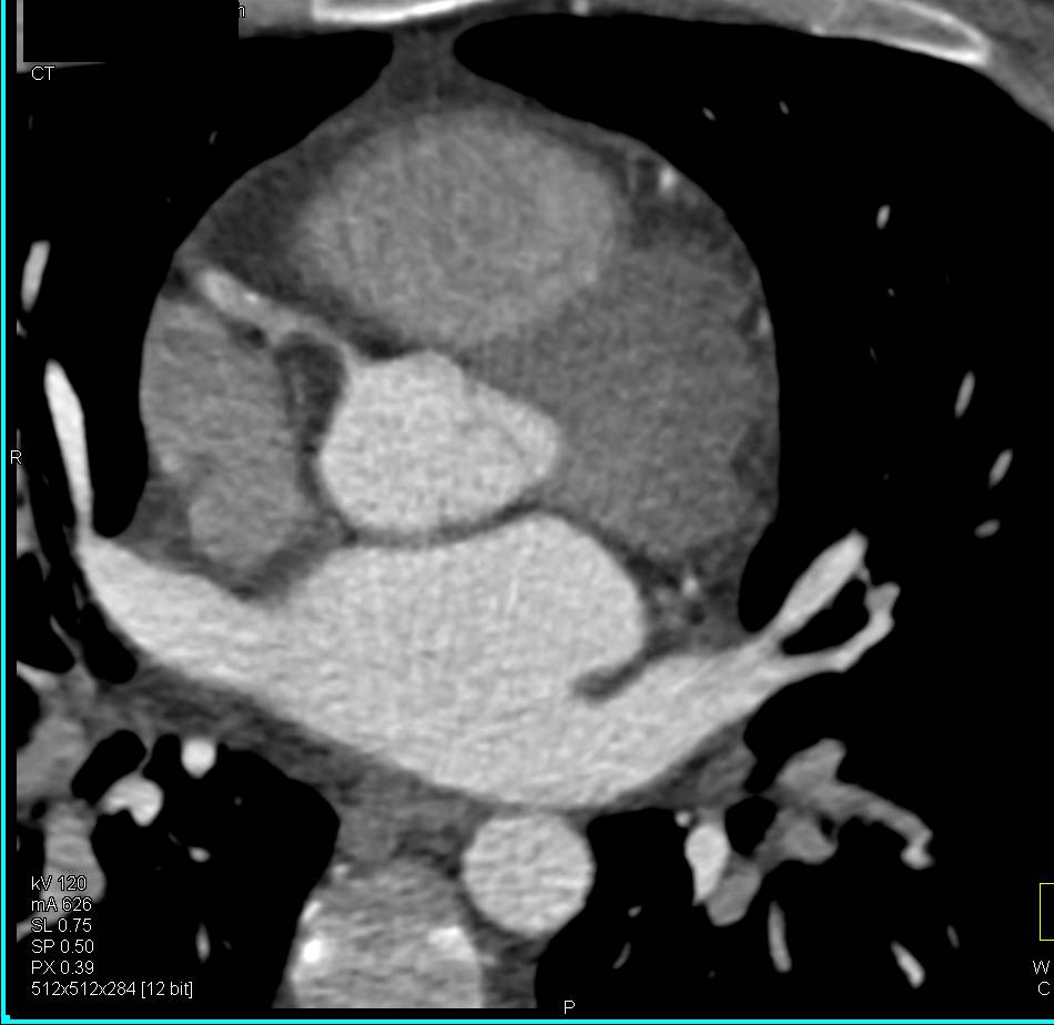 Critical Stenosis Right Coronary Artery - CTisus CT Scan