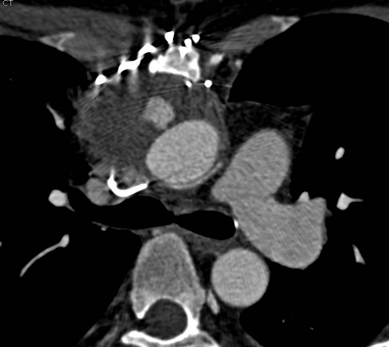 Pseudoaneurysm off the Ascending Aorta - CTisus CT Scan