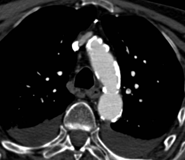 Extensive Aortic Valve Calcifications - CTisus CT Scan