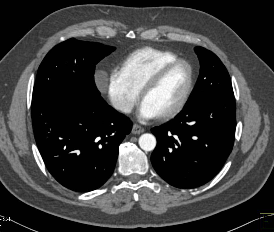 Pericardial Cyst - CTisus CT Scan