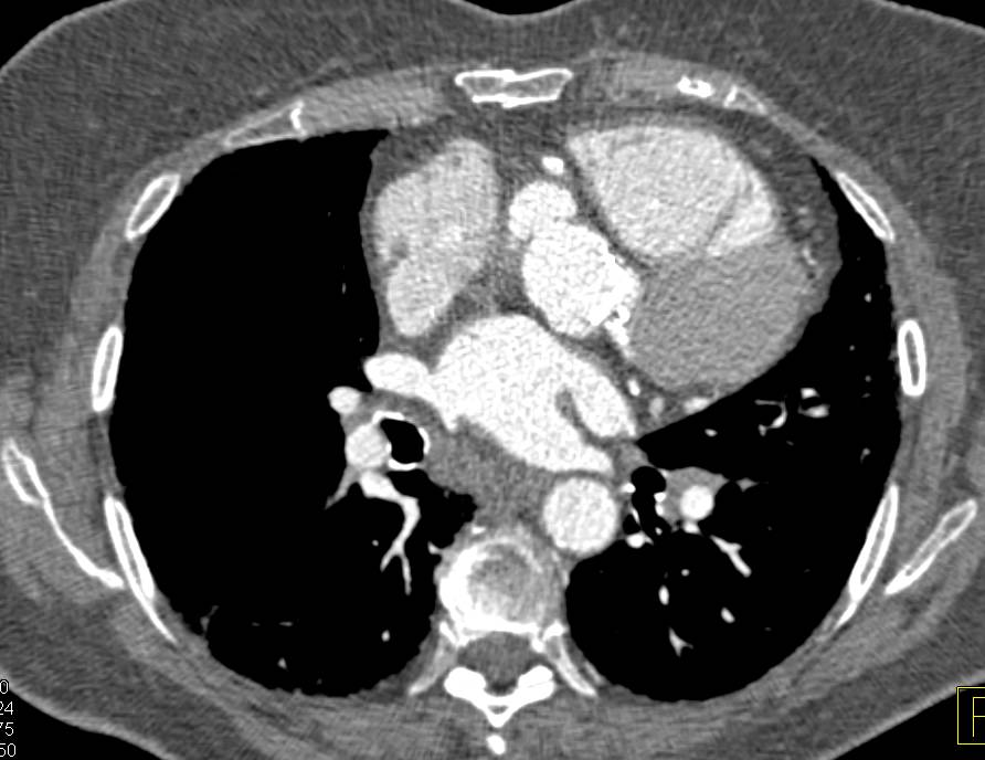 Pseudoaneurysm off the Ascending Aorta at Site of Repair - CTisus CT Scan