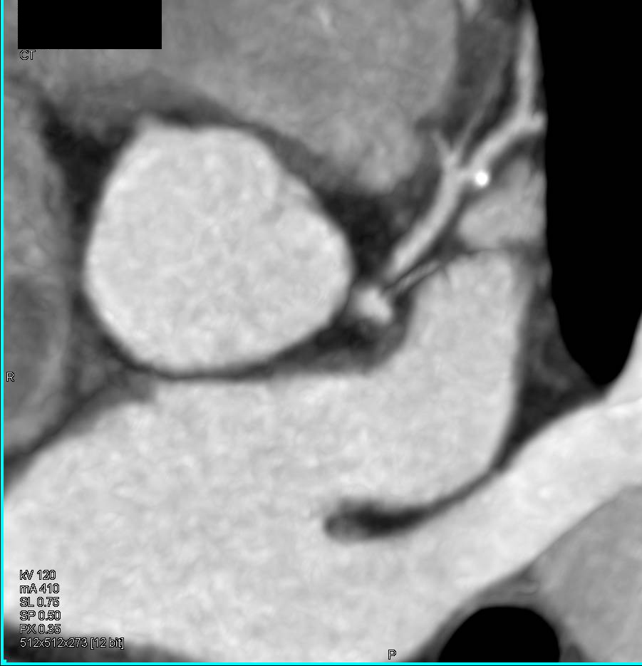 CCTA: Left Anterior Descending Artery (LAD) Disease - CTisus CT Scan