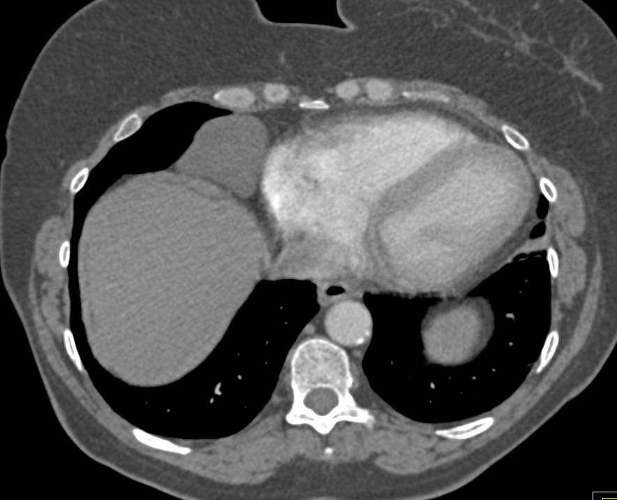 Incidental Pericardial Cyst in a Patient with a Desmoid Tumor in the Right Rectus Muscle - CTisus CT Scan
