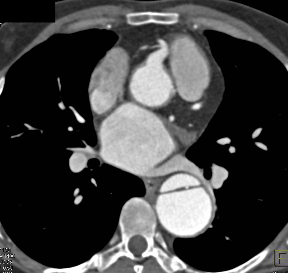 Type A Dissection with Repair and Aortic Valve Replacement (AVR) and Dilated Re-implanted Right Coronary Artery - CTisus CT Scan