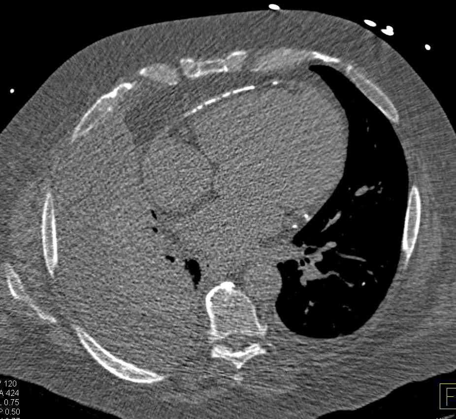 Constrictive Pericarditis due to Extensive Pericardial Calcification - CTisus CT Scan