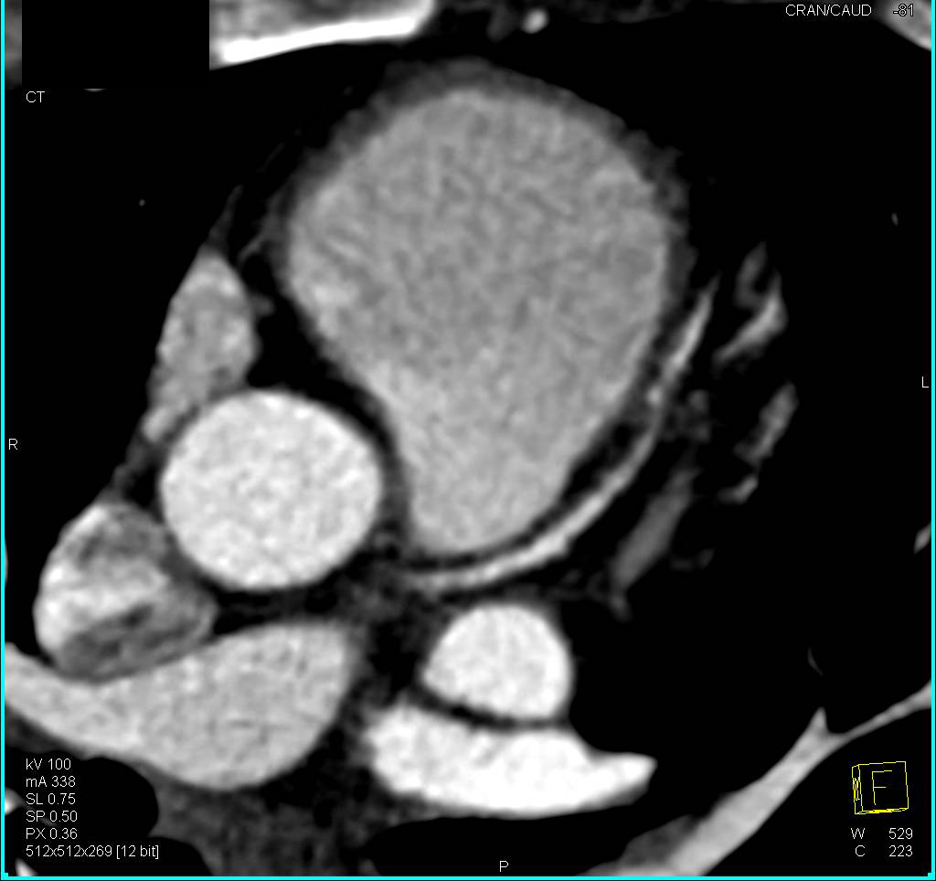 CCTA: Calcified Left Anterior Descending Coronary Artery (LAD) Plaque - CTisus CT Scan