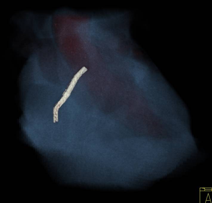 CCTA: Patent Coronary Stent - CTisus CT Scan