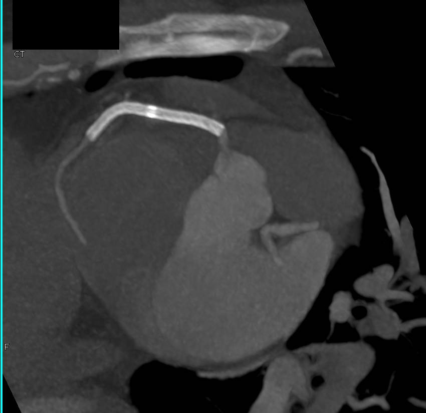 CCTA: Patent Stent in Right Coronary Artery - CTisus CT Scan