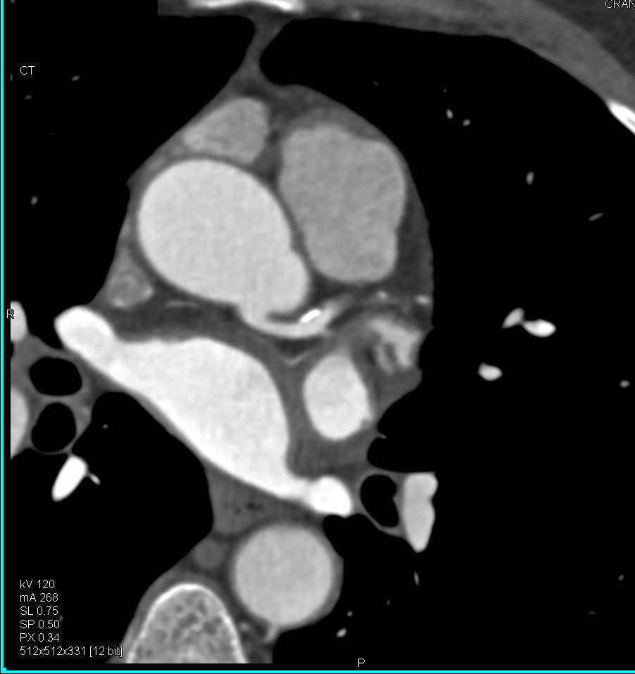 Calcified Left Anterior Descending Coronary Artery (LAD) Plaque without Critical Stenosis - CTisus CT Scan