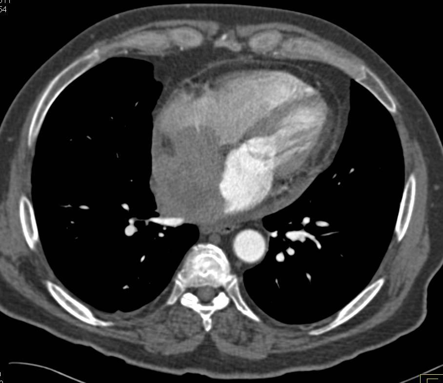 B Cell Involves the Left and Right Atrium and the Terminal Ileum - CTisus CT Scan