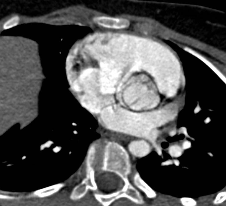 Bicuspid Aortic Valve - CTisus CT Scan