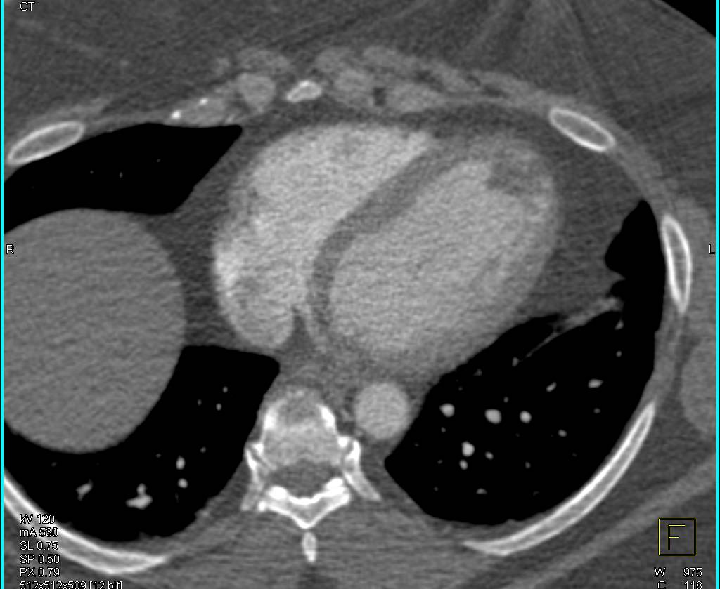 Thrombus in Apex of Left Ventricle - CTisus CT Scan