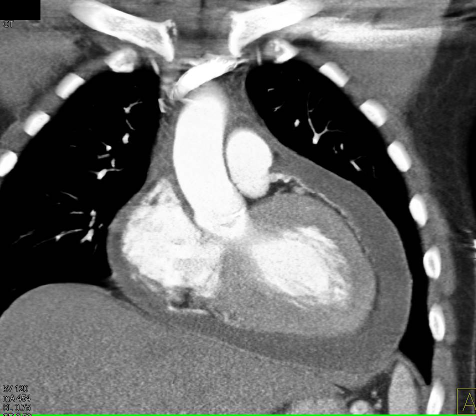 Large Pericardial Effusion - CTisus CT Scan