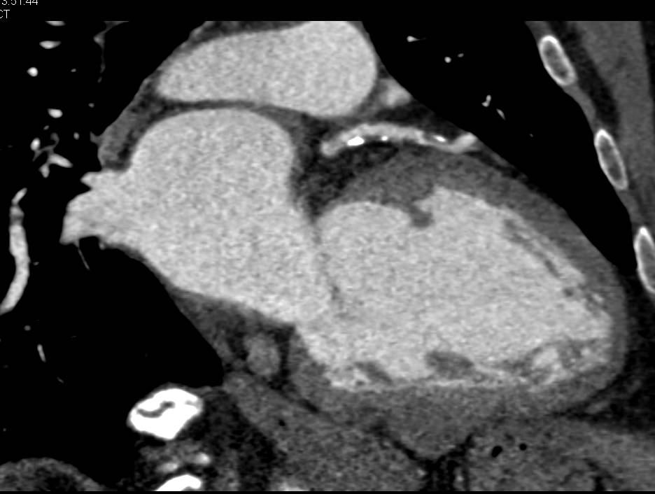 CCTA: Mixed Plaque Left Anterior Descending Coronary Artery (LAD) with a 70% Stenosis - CTisus CT Scan