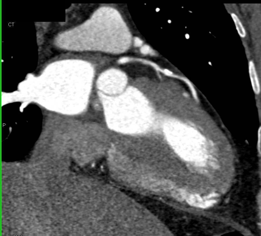 CCTA: Mixed Plaque Left Anterior Descending Coronary Artery (LAD) - CTisus CT Scan