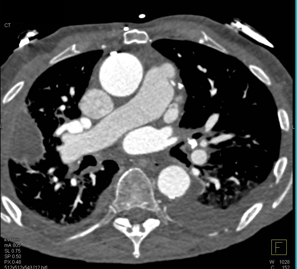 Beautiful 3D VRTs of Coronary Artery Bypass Graft (CABG) with Venous and Left Internal Mammary Artery (LIMA) Grafts - CTisus CT Scan