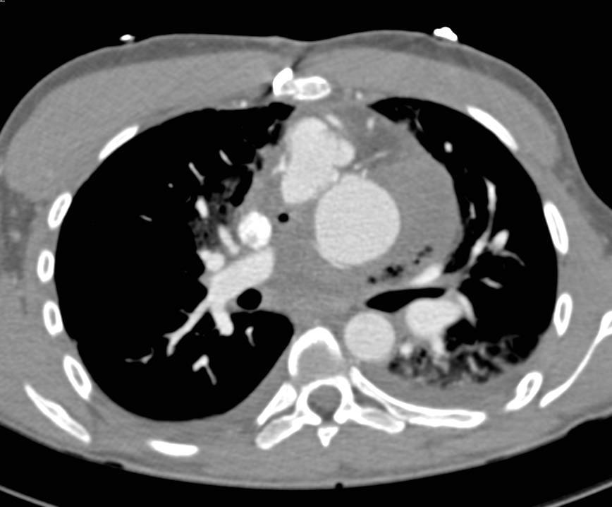 Complex Cardiac Surgery in a Patient with a History of Transposition of the Great Vessels - CTisus CT Scan