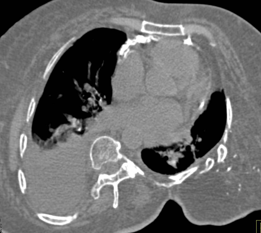 Extensive Pericardial Calcification - CTisus CT Scan