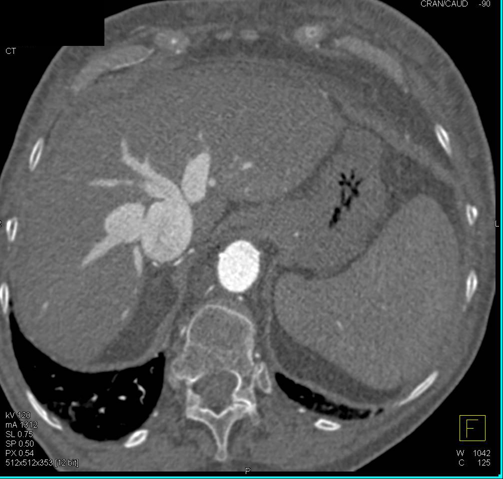 Poor Right Sided Heart Function with Reflux of Contrast into the ...