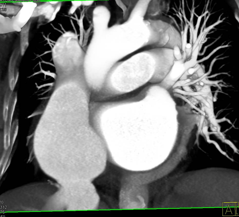 Dilated Inferior Vena Cava (IVC) with Right Sided Heart Failure - CTisus CT Scan