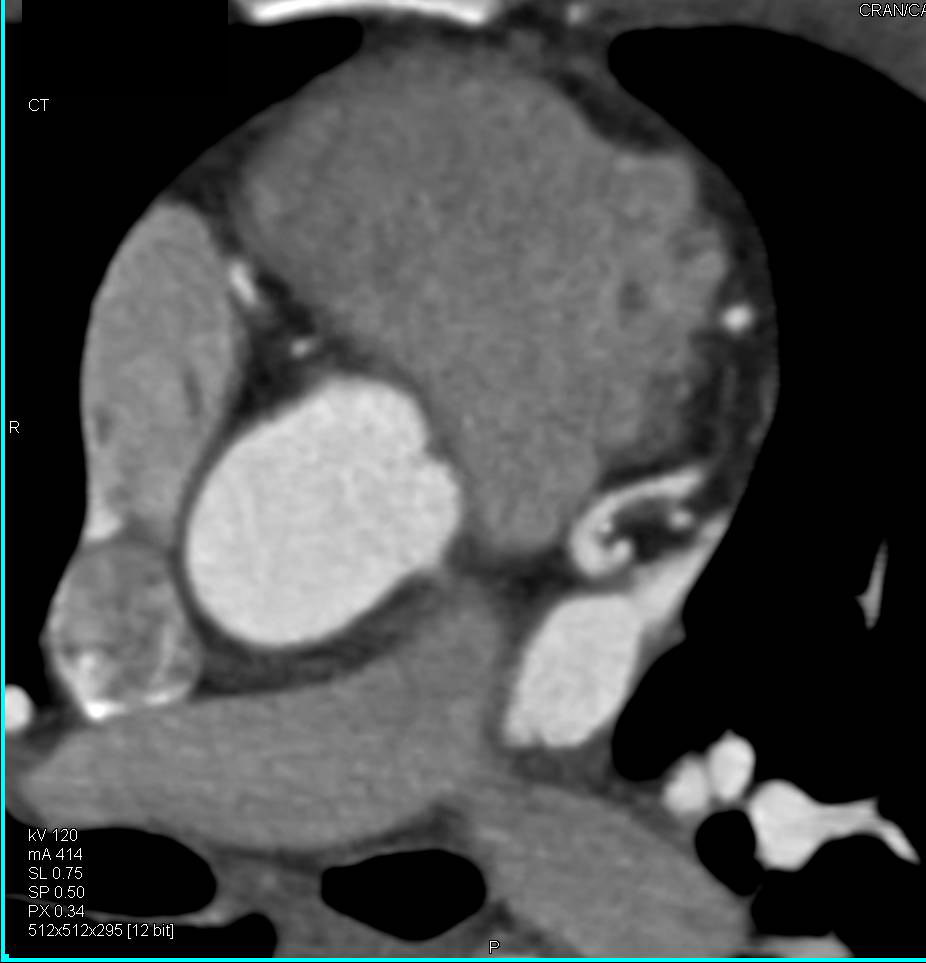 CCTA: Left Anterior Descending Artery (LAD) Mixed Plaque with a 50% or so Stenosis best seen on Sagittal Cuts Through the LAD - CTisus CT Scan