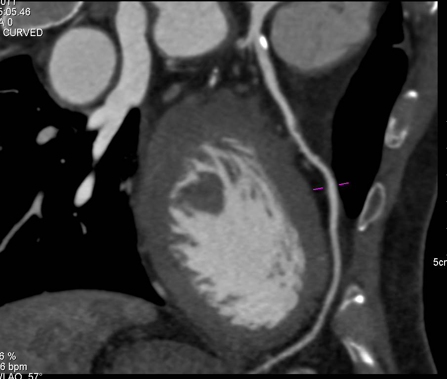 CCTA: Mixed Plaque in the Left Anterior Descending Coronary Artery (LAD) - CTisus CT Scan