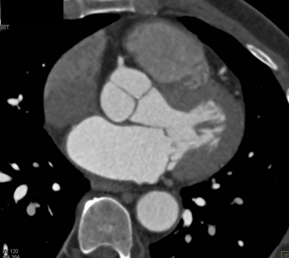 CCTA: Multivessel Disease Especially Left Anterior Descending Coronary Artery (LAD) with Mixed Plaque - CTisus CT Scan