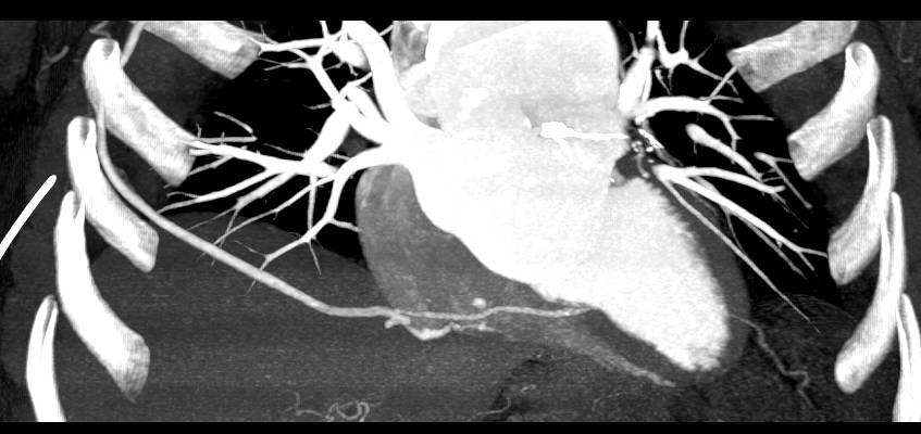 Amazing Graft from the Axillary Artery to the Right Coronary Artery - CTisus CT Scan