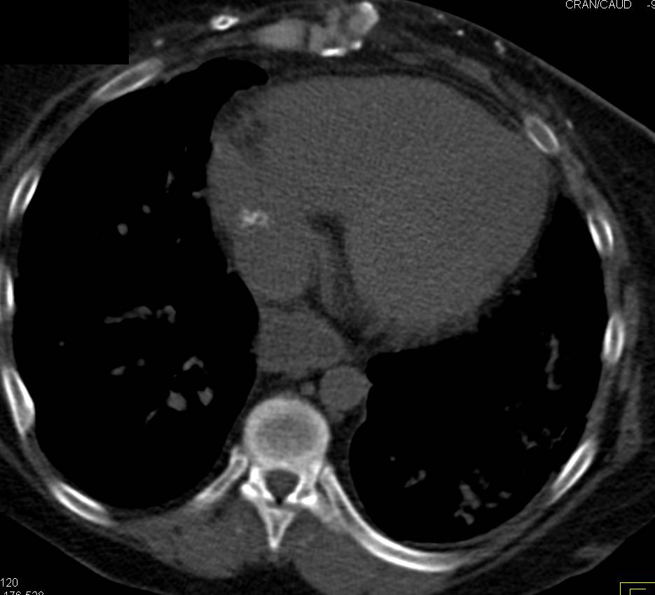 Thrombus in Right Atrium Calcifies Over Time - CTisus CT Scan